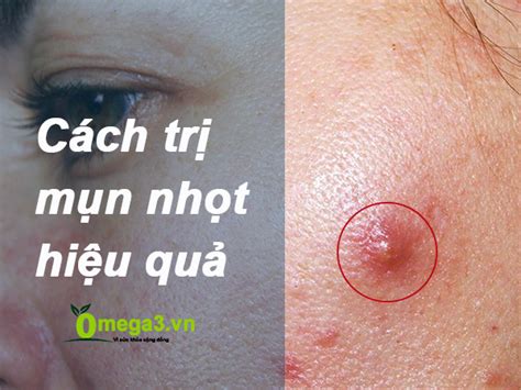 Bật mí 16 cách trị mụn nhọt ở mông tại nhà hiệu quả nhanh nhất.